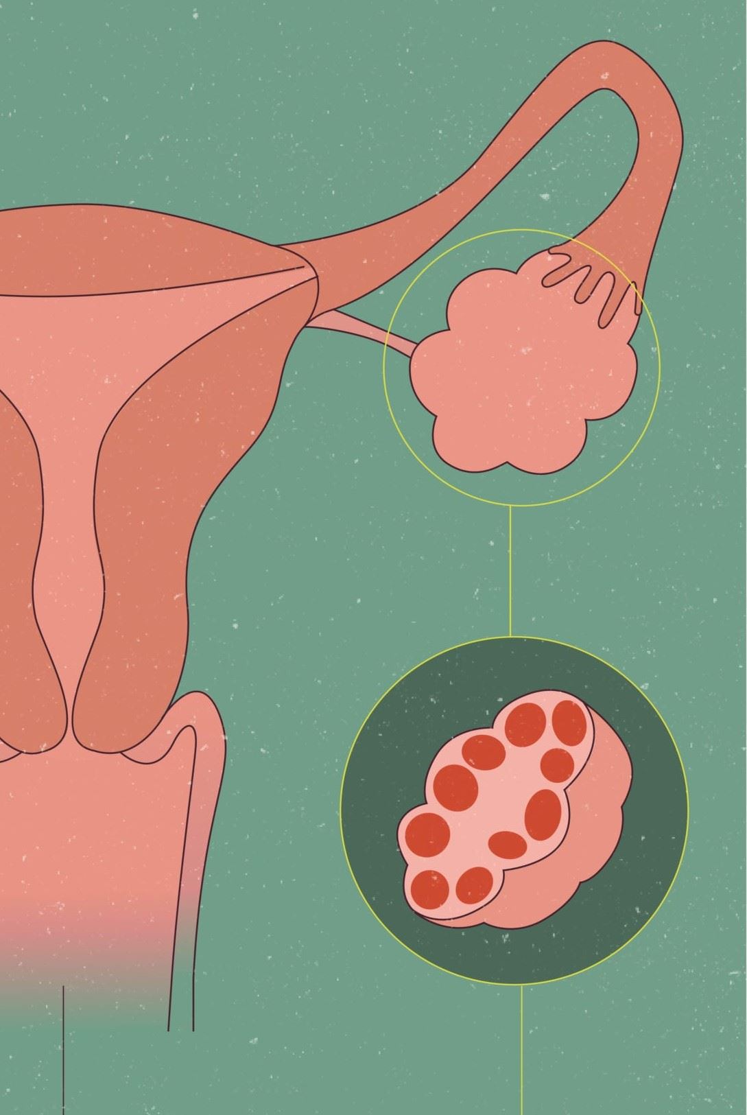 Infografika z przekrojem jajnika z torbielami.